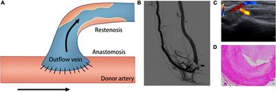 Oxidative stress: An essential factor in the process of arteriovenous fistula failure
